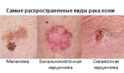 РАК КОЖИ 1, 2, 3, 4 стадии степени. Лечение Меланомы, Базалиомы в Киеве