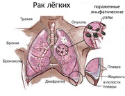 РАК ЛЕГКОГО (ЛЕГКИХ) 1, 2, 3, 4 стадии степени. Лечение в Киеве.