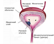 РАК МОЧЕВОГО ПУЗЫРЯ 1, 2, 3, 4 стадии степени. Диагностика, лечение опухоли мочевого пузыря в Киеве