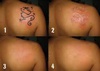 Tatoo Remover Cream In Empangeni+27 81 850 2816